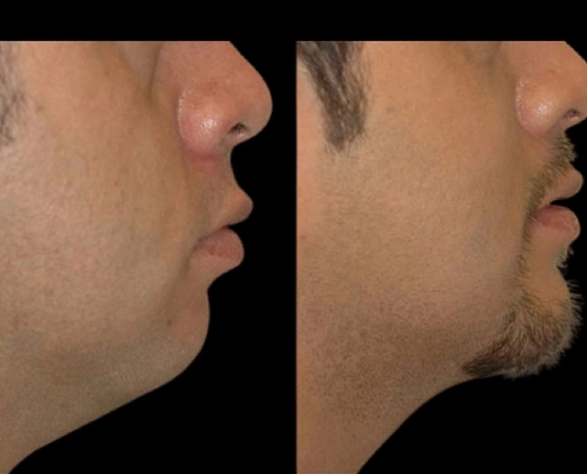 Why Experience Matters: Best Doctors in Dubai for Double Chin Removal