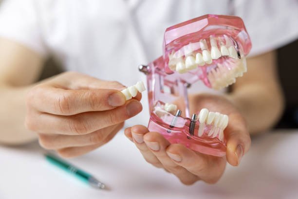 Discover the Benefits of One-Day Dental Implants in Fort Worth