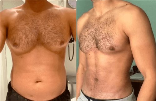 Gynecomastia in Dubai: Transforming Lives with Expert Care